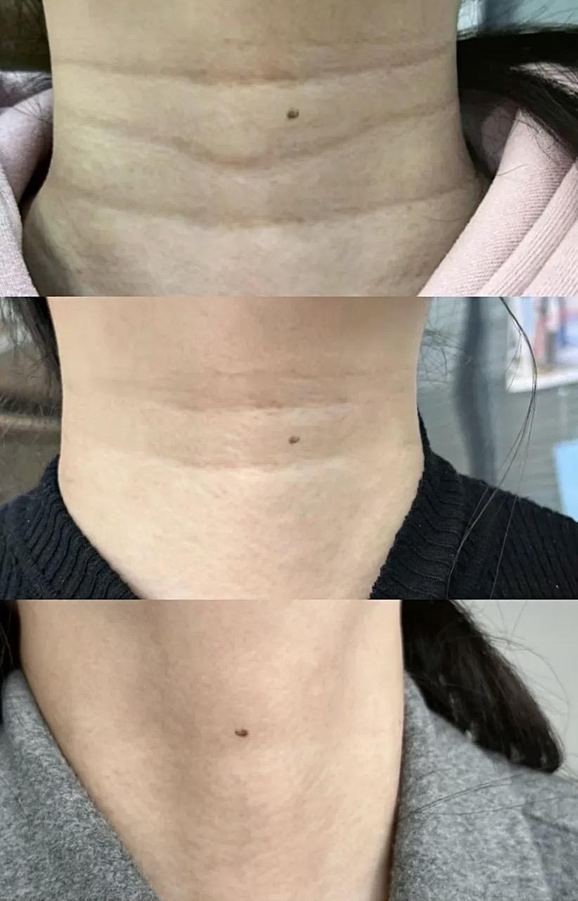 颈纹霜效果对比_颈肩腰腿疼培训_颈部护理方法