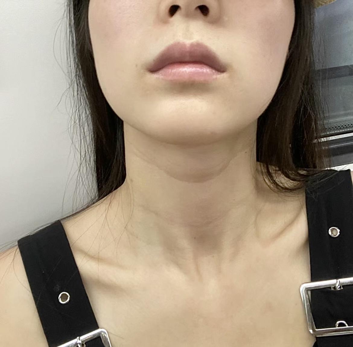 颈纹霜效果对比_颈部护理方法_颈肩腰腿疼培训