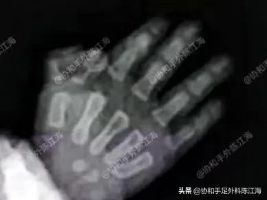 蟹钳样多指手术_IV-D型多指_做多指手术要多少钱