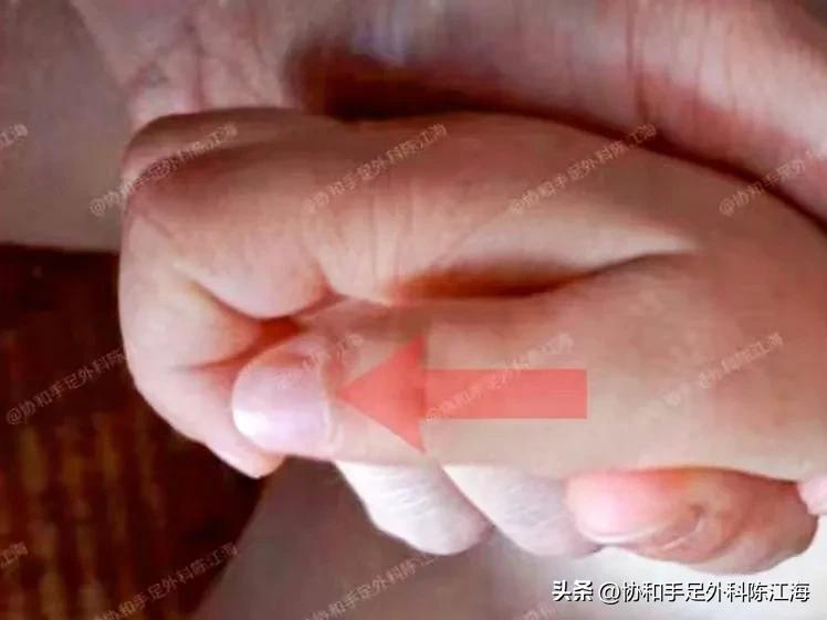 蟹钳样多指手术_IV-D型多指_做多指手术要多少钱