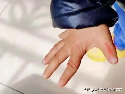 做多指手术要多少钱_蟹钳样多指手术_IV-D型多指