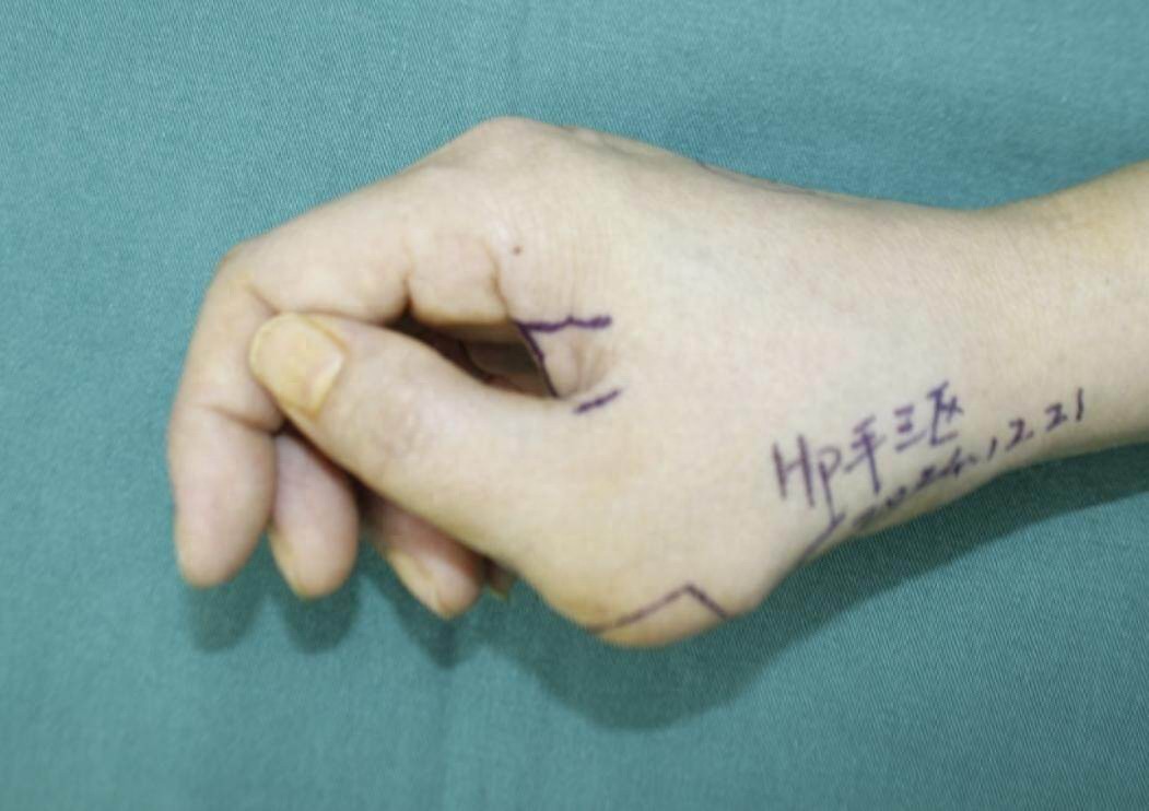 多指畸形手术没做好？成年后二次矫正，费用花多少？