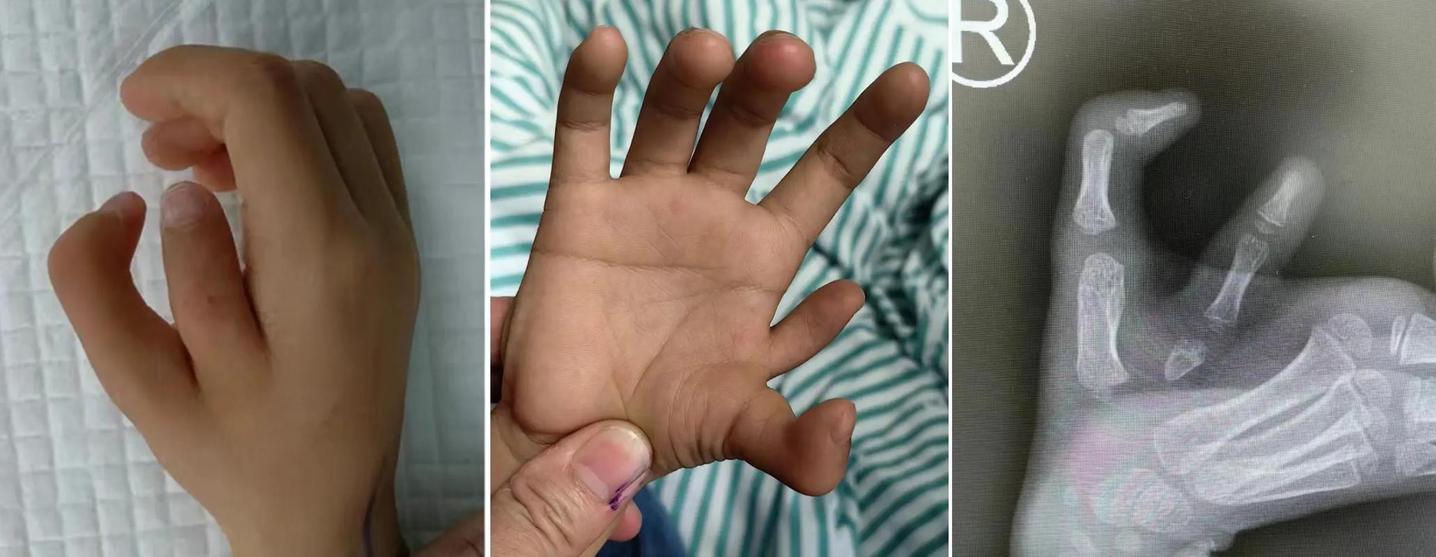 多指切除简单一刀切术后仍需二次矫正_做多指手术要多少钱_36岁多指畸形术后仍畸形